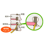 椎間板ヘルニア　Hernia of the intervertebral disk